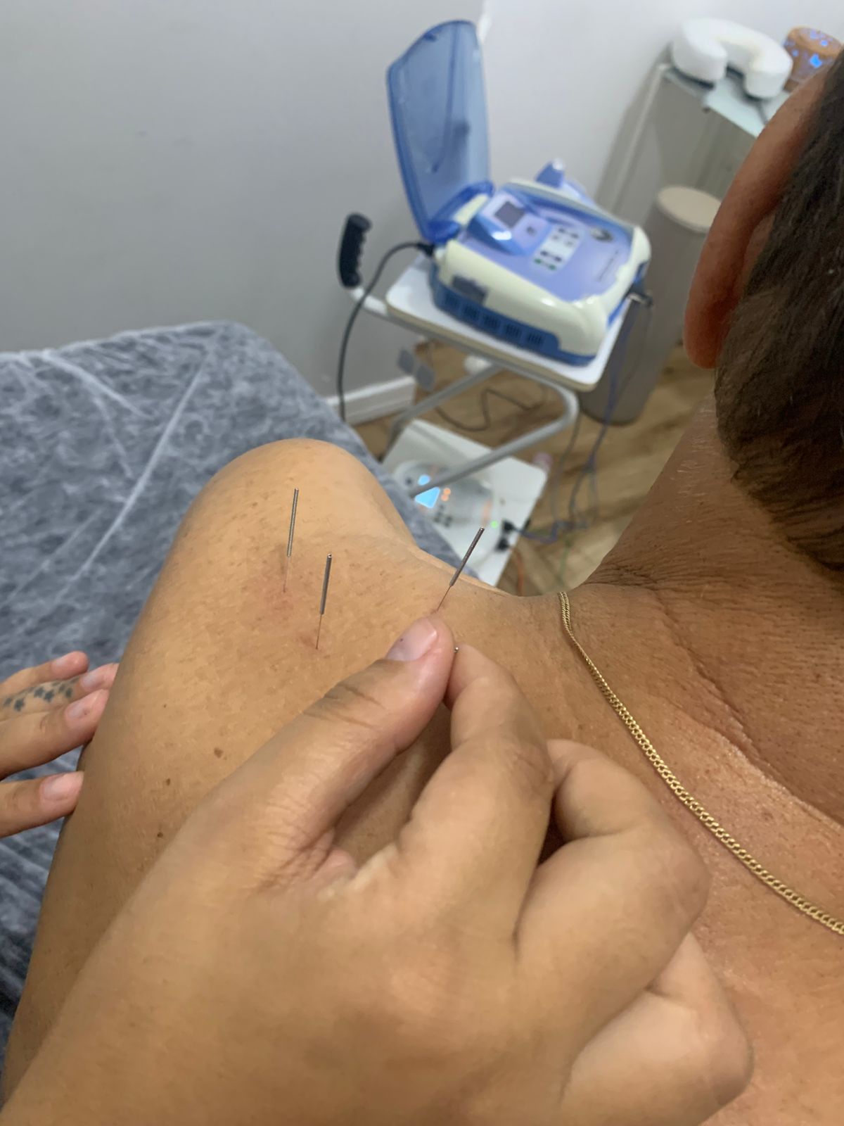 img-dry-needling-1