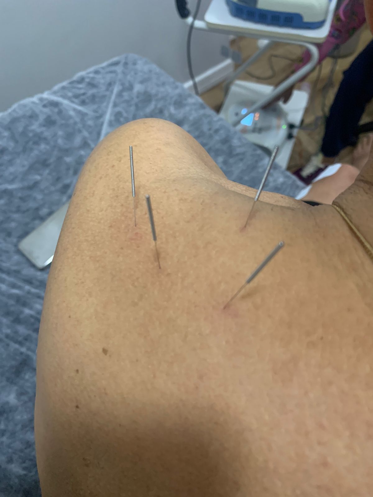 img-dry-needling-2